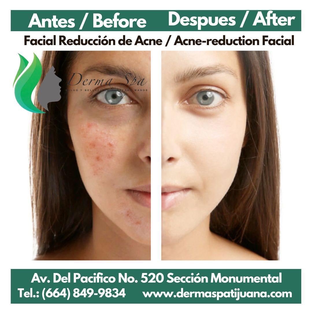 DermSpaacne