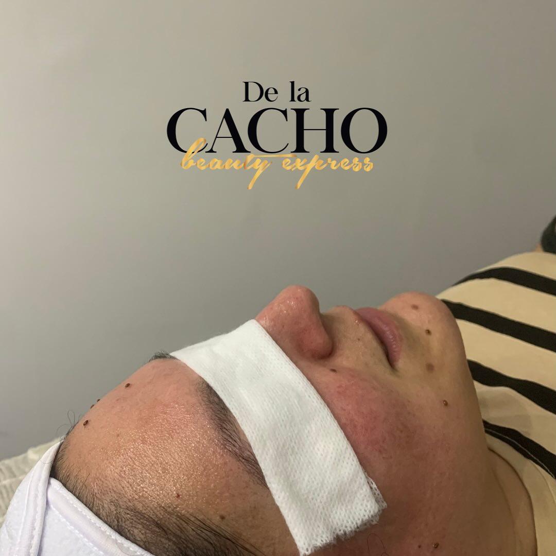 delacacho facial