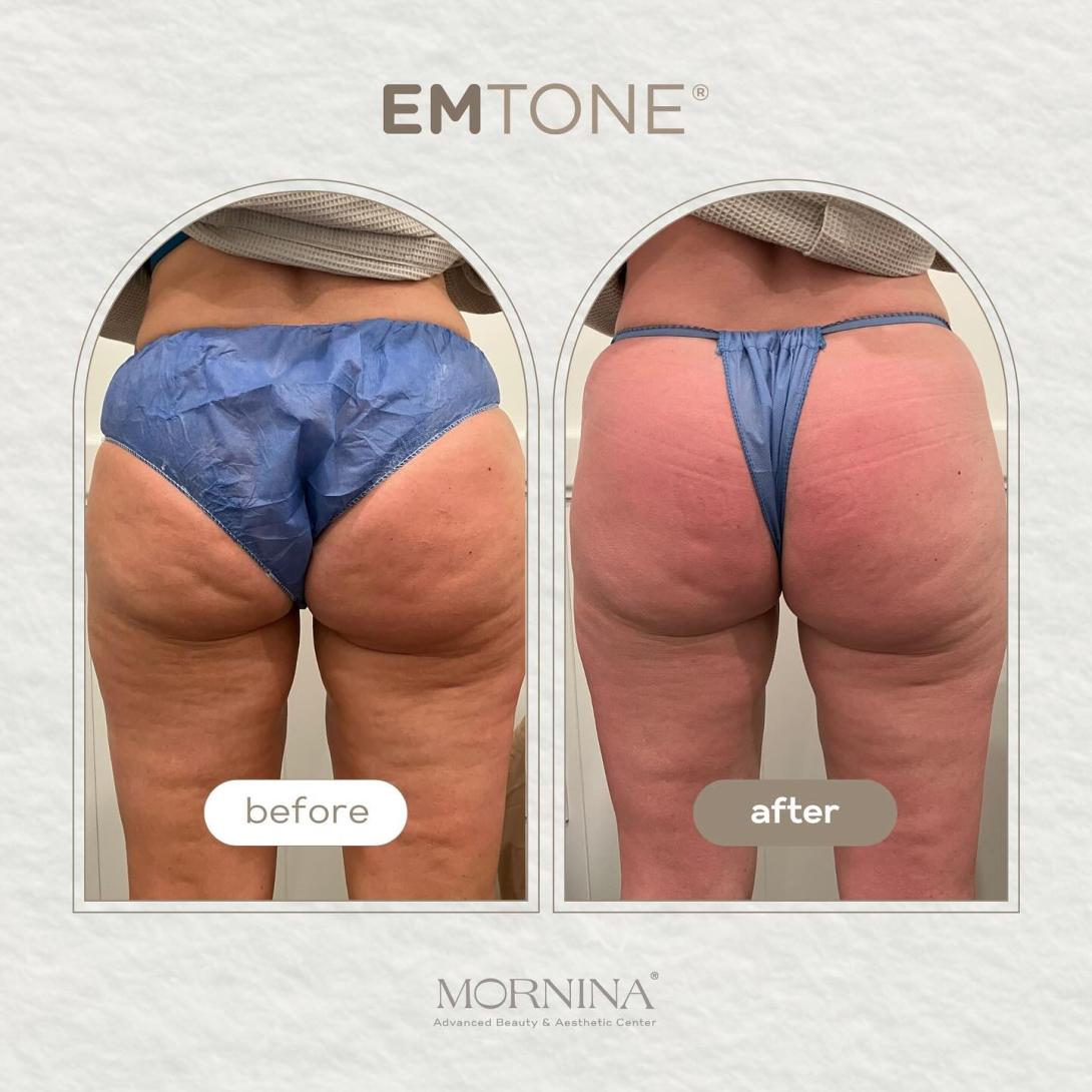 Mornina butt
