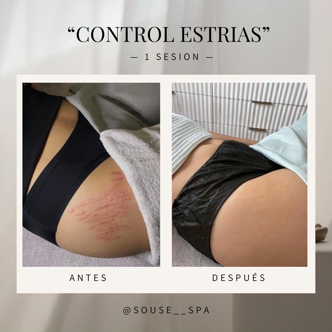 Souse estrias