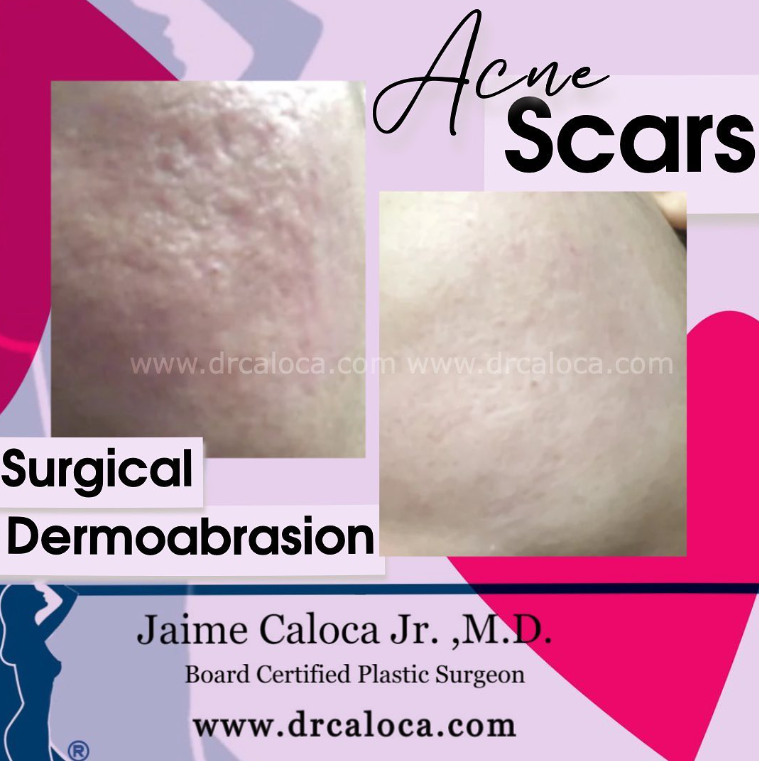 caloca scars