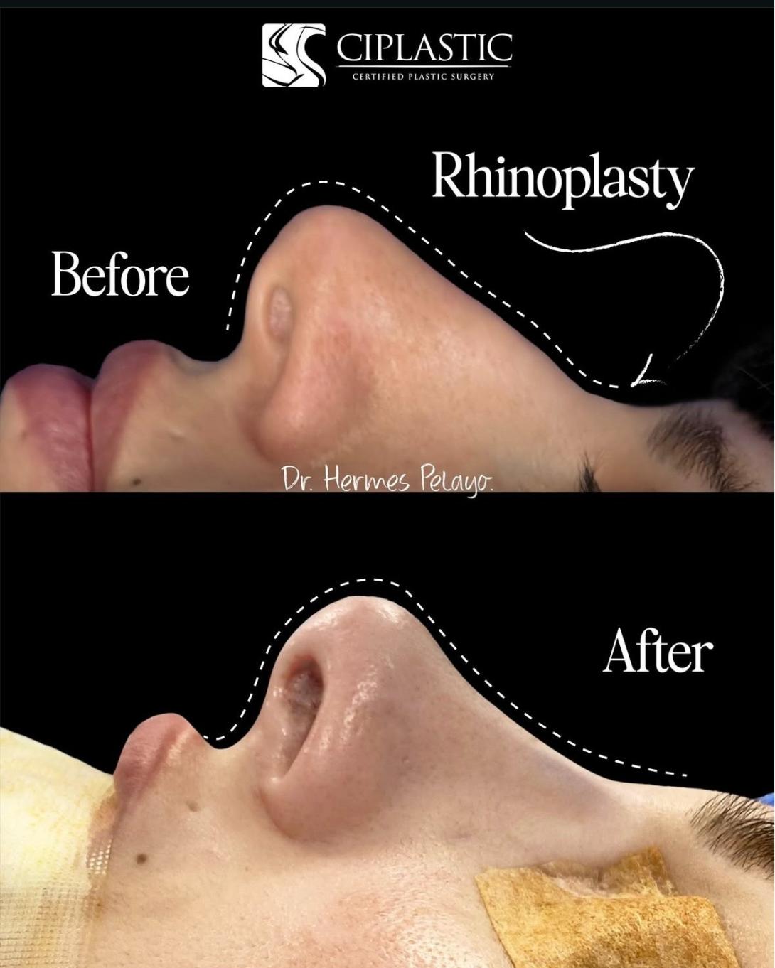 CIPnose