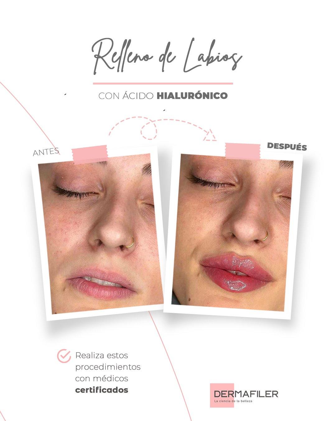 dermafiler labios