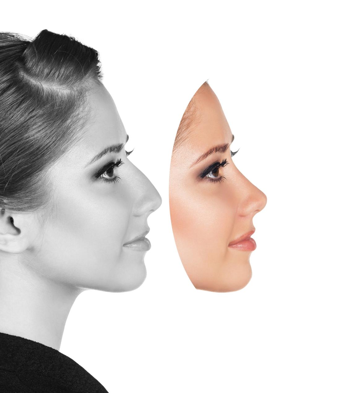 dermafiler nariz